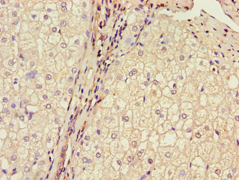 Brain Protein 44 / BRP44 Antibody - Immunohistochemistry of paraffin-embedded human liver cancer using MPC2 Antibody at dilution of 1:100