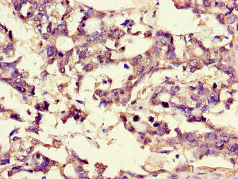 Brain Protein 44 / BRP44 Antibody - Immunohistochemistry of paraffin-embedded human gastric cancer using MPC2 Antibody at dilution of 1:100
