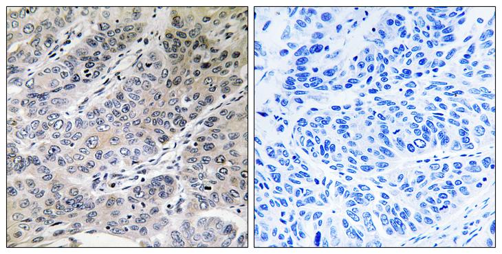 Brain Protein 44 / BRP44 Antibody - Peptide - + Immunohistochemistry analysis of paraffin-embedded human lung carcinoma tissue using BRP44 antibody.