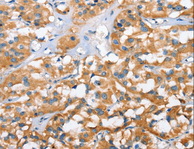 BRAK / CXCL14 Antibody - Immunohistochemistry of paraffin-embedded Human thyroid cancer using CXCL14 Polyclonal Antibody at dilution of 1:40.
