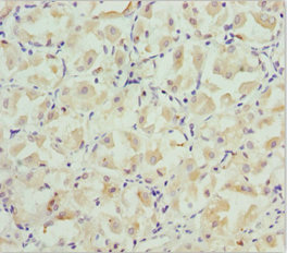 BRAK / CXCL14 Antibody - Immunohistochemistry of paraffin-embedded human gastric cancer at dilution 1:100