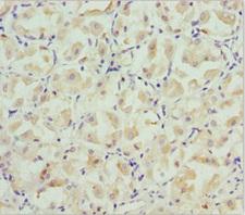 BRAK / CXCL14 Antibody - Immunohistochemistry of paraffin-embedded human gastric cancer at dilution 1:100
