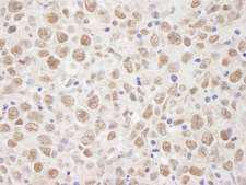 BRAT1 / BAAT1 Antibody - Detection of Human BAAT1 by Immunohistochemistry. Sample: FFPE section of human metastatic lymph node. Antibody: Affinity purified rabbit anti-BAAT1 used at a dilution of 1:250. Detection: DAB staining using anti-Rabbit IHC antibody at a dilution of 1:100.