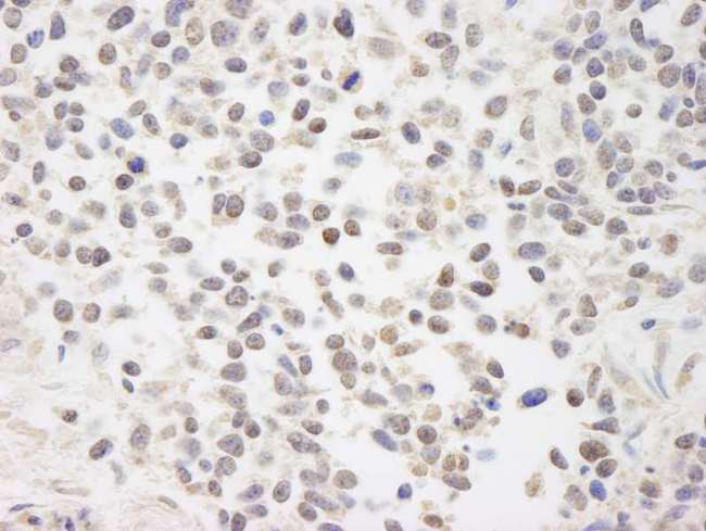 BRAT1 / BAAT1 Antibody - Detection of Human BAAT1 by Immunohistochemistry. Sample: FFPE section of human lung non-small cell cancer. Antibody: Affinity purified rabbit anti-BAAT1 used at a dilution of 1:250. Detection: DAB staining using anti-Rabbit IHC antibody at a dilution of 1:100.