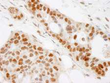 BRAT1 / BAAT1 Antibody - Detection of Human BAAT1 by Immunohistochemistry. Sample: FFPE section of human ovarian carcinoma. Antibody: Affinity purified rabbit anti-BAAT1 used at a dilution of 1:200 (1 ug/ml).
