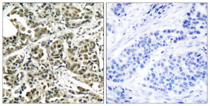 BRCA1 Antibody - Immunohistochemistry analysis of paraffin-embedded human breast carcinoma tissue, using BRCA1 Antibody. The picture on the right is blocked with the synthesized peptide.