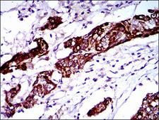 BRCA1 Antibody - IHC of paraffin-embedded esophagus cancer tissues using BRCA1 mouse monoclonal antibody with DAB staining.