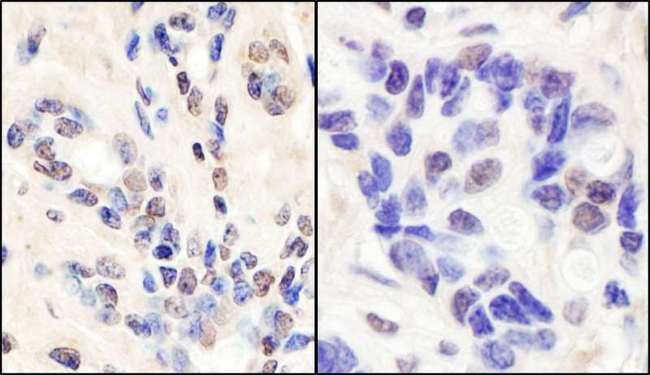 BRCA1 Antibody - Detection of Human BRCA1 by Immunohistochemistry. Samples: FFPE section of human breast carcinoma (left) and ovarian carcinoma (right). Antibody: Affinity purified rabbit anti-BRCA1 used at a dilution of 1:1000 (1 ug/ml).