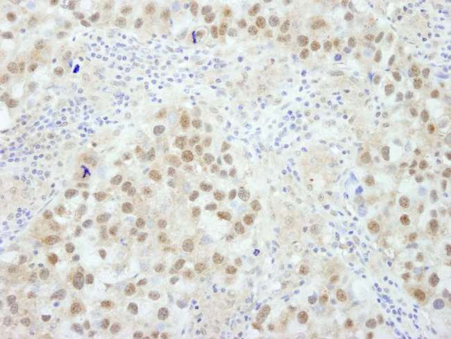 BRCA1 Antibody - Detection of Human BRCA1 by Immunohistochemistry. Sample: FFPE section of human breast carcinoma. Antibody: Affinity purified rabbit anti-BRCA1 used at a dilution of 1:250.
