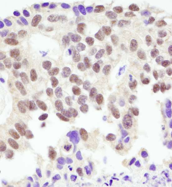 BRCA1 Antibody - Detection of Human BRCA1 by Immunohistochemistry. Sample: FFPE section of human breast carcinoma. Antibody: Affinity purified rabbit anti-BRCA1 used at a dilution of 1:1000 (1 ug/ml).