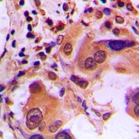 BRCA1 Antibody - Immunohistochemical analysis of BRCA1 (pS1423) staining in human lung cancer formalin fixed paraffin embedded tissue section. The section was pre-treated using heat mediated antigen retrieval with sodium citrate buffer (pH 6.0). The section was then incubated with the antibody at room temperature and detected using an HRP polymer system. DAB was used as the chromogen. The section was then counterstained with hematoxylin and mounted with DPX.