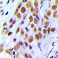 BRCA1 Antibody - Immunohistochemical analysis of BRCA1 staining in human breast cancer formalin fixed paraffin embedded tissue section. The section was pre-treated using heat mediated antigen retrieval with sodium citrate buffer (pH 6.0). The section was then incubated with the antibody at room temperature and detected using an HRP polymer system. DAB was used as the chromogen. The section was then counterstained with hematoxylin and mounted with DPX.