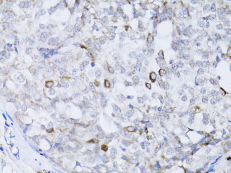 BRCA1 Antibody - Immunohistochemistry of paraffin-embedded human breast cancer using BRCA1 antibody at dilution of 1:100 (40x lens).