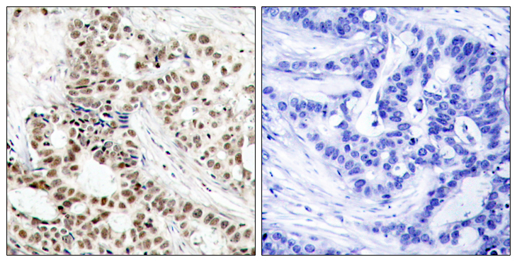 BRCA1 Antibody - Immunohistochemistry analysis of paraffin-embedded human breast carcinoma, using BRCA1 (Phospho-Ser1423) Antibody. The picture on the right is blocked with the phospho peptide.