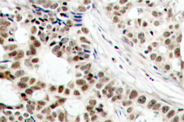 BRCA1 Antibody - IHC of p-BRCA1 (S1423) pAb in paraffin-embedded human breast carcinoma tissue.