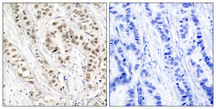 BRCA1 Antibody - Immunohistochemistry analysis of paraffin-embedded human breast carcinoma, using BRCA1 (Phospho-Ser1524) Antibody. The picture on the right is blocked with the phospho peptide.