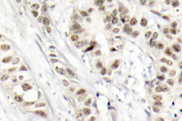 BRCA1 Antibody - IHC of p-BRCA1 (S1524) pAb in paraffin-embedded human breast carcinoma tissue.