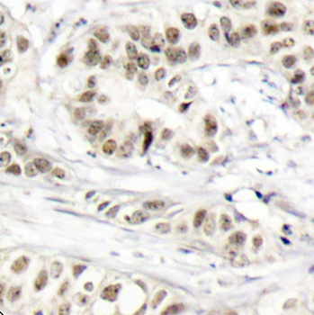 BRCA1 Antibody - Immunohistochemical analysis of paraffin-embedded human breast carcinoma tissue.