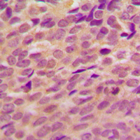 BRCA1 Antibody - Immunohistochemical analysis of BRCA1 (pS1524) staining in human breast cancer formalin fixed paraffin embedded tissue section. The section was pre-treated using heat mediated antigen retrieval with sodium citrate buffer (pH 6.0). The section was then incubated with the antibody at room temperature and detected using an HRP conjugated compact polymer system. DAB was used as the chromogen. The section was then counterstained with hematoxylin and mounted with DPX.