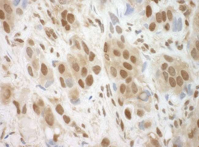 BRCC3 / BRCC36 Antibody - Detection of Human BRCC36 by Immunohistochemistry. Sample: FFPE section of human breast carcinoma. Antibody: Affinity purified rabbit anti-BRCC36 used at a dilution of 1:250.