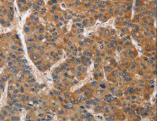 BRCC45 / BRE Antibody - Immunohistochemistry of paraffin-embedded Human liver cancer using BRE Polyclonal Antibody at dilution of 1:40.