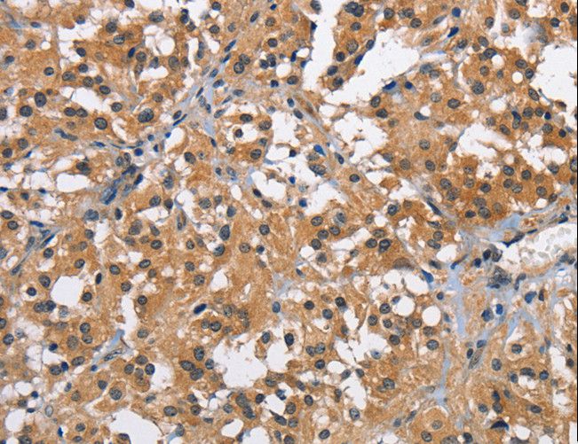 BRCC45 / BRE Antibody - Immunohistochemistry of paraffin-embedded Human thyroid cancer using BRE Polyclonal Antibody at dilution of 1:40.