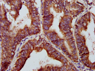 BRCC45 / BRE Antibody - Immunohistochemistry Dilution at 1:200 and staining in paraffin-embedded human endometrial cancer performed on a Leica BondTM system. After dewaxing and hydration, antigen retrieval was mediated by high pressure in a citrate buffer (pH 6.0). Section was blocked with 10% normal Goat serum 30min at RT. Then primary antibody (1% BSA) was incubated at 4°C overnight. The primary is detected by a biotinylated Secondary antibody and visualized using an HRP conjugated SP system.