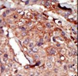 BRD2 / RING3 Antibody - Formalin-fixed and paraffin-embedded human cancer tissue reacted with the primary antibody, which was peroxidase-conjugated to the secondary antibody, followed by AEC staining. This data demonstrates the use of this antibody for immunohistochemistry; clinical relevance has not been evaluated. BC = breast carcinoma; HC = hepatocarcinoma.