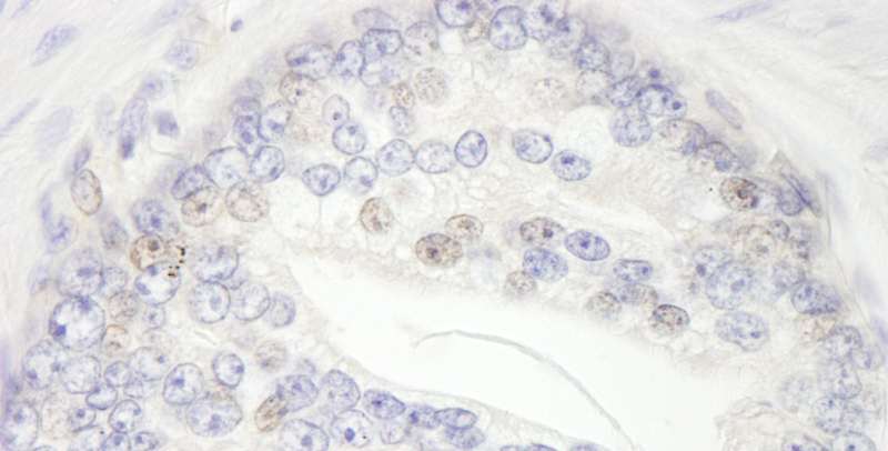 BRD3 Antibody - Detection of Human BRD3 by Immunohistochemistry. Sample: FFPE section of human prostate carcinoma. Antibody: Affinity purified rabbit anti-BRD3 used at a dilution of 1:200 (1 ug/ml).