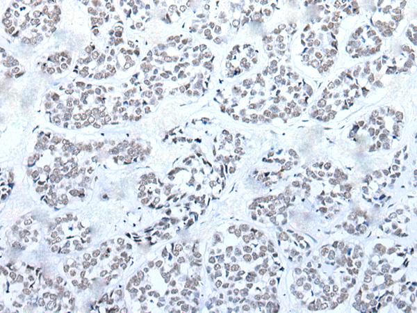 BRD3 Antibody - Immunohistochemistry of paraffin-embedded Human esophagus cancer tissue  using BRD3 Polyclonal Antibody at dilution of 1:60(×200)