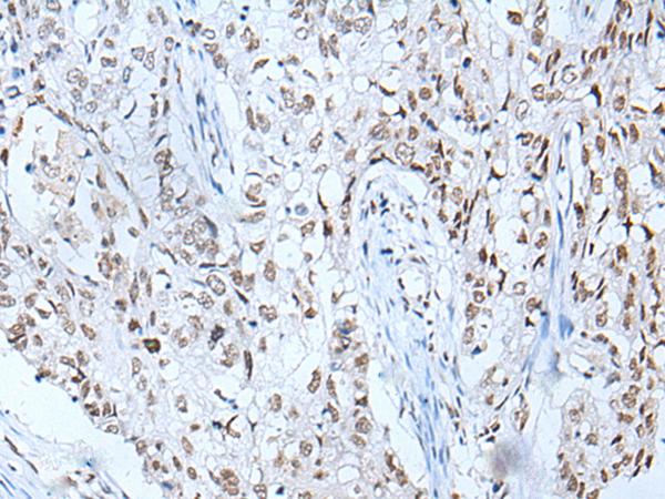 BRD3 Antibody - Immunohistochemistry of paraffin-embedded Human lung cancer tissue  using BRD3 Polyclonal Antibody at dilution of 1:60(×200)