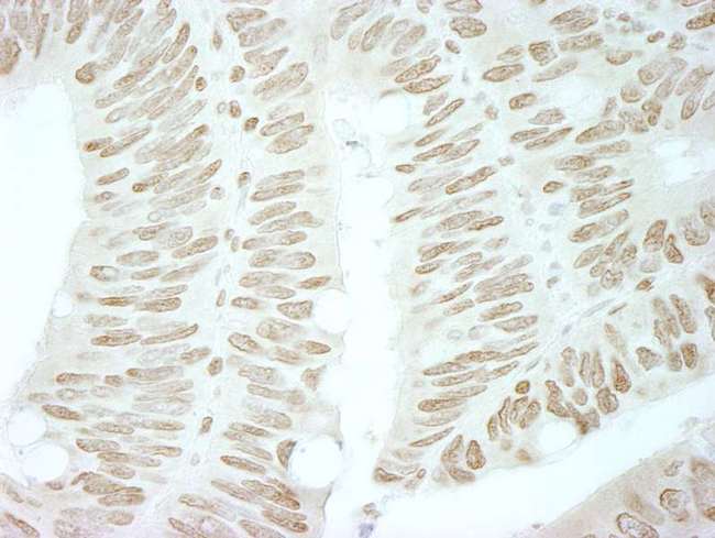 BRD4 Antibody - Detection of Human BRD4 by Immunohistochemistry. Sample: FFPE section of human colon carcinoma. Antibody: Affinity purified rabbit anti-BRD4 used at a dilution of 1:500. Epitope Retrieval Buffer-High pH (IHC-101J) was substituted for Epitope Retrieval Buffer-Reduced pH.