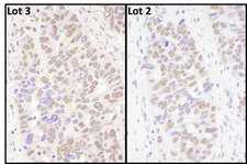BRD4 Antibody - Detection of Human BRD4 by Immunohistochemistry. Samples: FFPE sections of human ovarian carcinoma. Antibody: Affinity purified rabbit anti-BRD4 used at a dilution of 1:1000 (1 ug/ml).