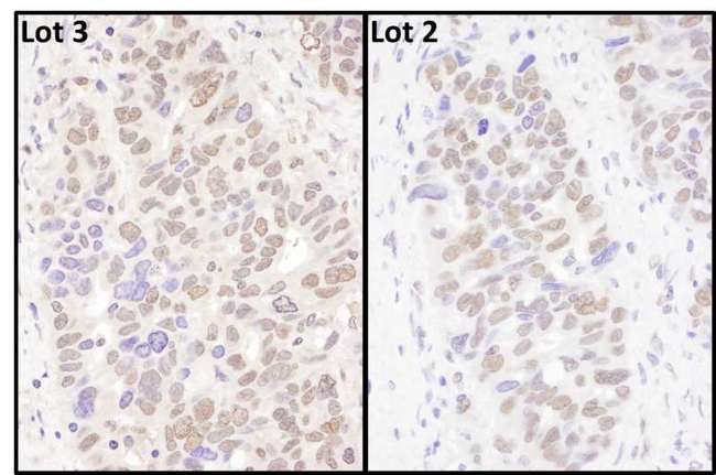 BRD4 Antibody - Detection of Human BRD4 by Immunohistochemistry. Samples: FFPE sections of human ovarian carcinoma. Antibody: Affinity purified rabbit anti-BRD4 used at a dilution of 1:1000 (1 ug/ml).