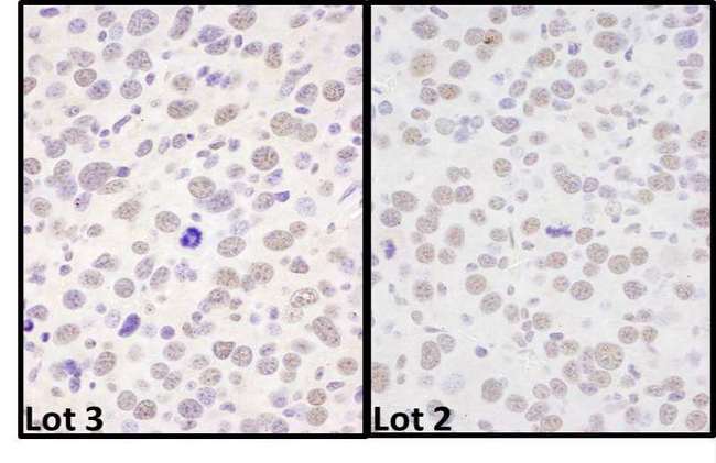 BRD4 Antibody - Detection of Mouse BRD4 by Immunohistochemistry. Samples: FFPE sections of mouse renal cell carcinoma. Antibody: Affinity purified rabbit anti-BRD4 used at a dilution of 1:1000 (1 ug/ml).