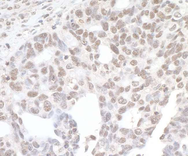 BRD4 Antibody - Detection of human BRD4 by immunohistochemistry. Sample: FFPE section of human ovarian carcinoma. Antibody: Affinity purified rabbit anti-BRD4 used at a dilution of 1:5,000 (0.2µg/ml). Detection: DAB