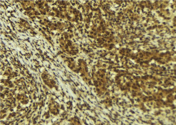 BRD4 Antibody - 1:100 staining human breast carcinoma tissue by IHC-P. The sample was formaldehyde fixed and a heat mediated antigen retrieval step in citrate buffer was performed. The sample was then blocked and incubated with the antibody for 1.5 hours at 22°C. An HRP conjugated goat anti-rabbit antibody was used as the secondary.