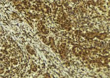 BRD4 Antibody - 1:100 staining human breast carcinoma tissue by IHC-P. The sample was formaldehyde fixed and a heat mediated antigen retrieval step in citrate buffer was performed. The sample was then blocked and incubated with the antibody for 1.5 hours at 22°C. An HRP conjugated goat anti-rabbit antibody was used as the secondary.
