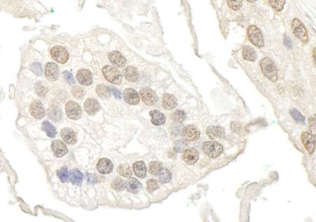 BRD7 Antibody - Detection of Human BRD7 by Immunohistochemistry. Sample: FFPE section of human prostate carcinoma. Antibody: Affinity purified rabbit anti-BRD7 used at a dilution of 1:250.