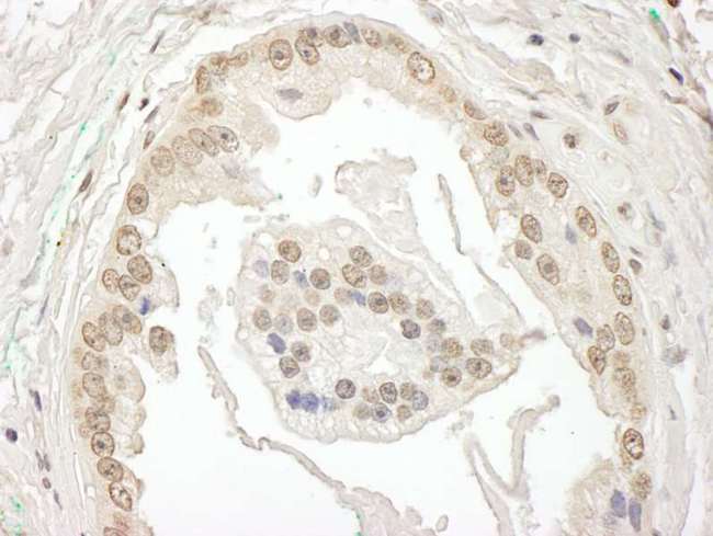 BRD7 Antibody - Detection of Human BRD7 by Immunohistochemistry. Sample: FFPE section of human prostate carcinoma. Antibody: Affinity purified rabbit anti-BRD7 used at a dilution of 1:1000 (1 ug/ml).