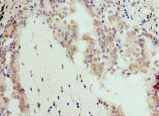 BRD7 Antibody - Paraffin-embedding Immunohistochemistry using human lung cancer at dilution 1:100