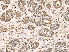 BRD7 Antibody - Immunohistochemistry of paraffin-embedded Human esophagus cancer tissue  using BRD7 Polyclonal Antibody at dilution of 1:50(×200)