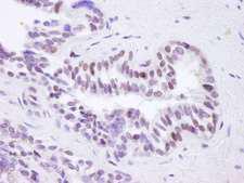 BRD8 Antibody - Detection of Human BRD8 by Immunohistochemistry. Sample: FFPE section of human prostate adenocarcinoma. Antibody: Affinity purified rabbit anti-BRD8 used at a dilution of 1:100. Detection: DAB.