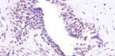 BRD8 Antibody - Detection of Human BRD8 by Immunohistochemistry. Sample: FFPE section of human prostate carcinoma. Antibody: Affinity purified rabbit anti-BRD8 used at a dilution of 1:1000 (1 ug/ml). Detection: DAB staining using Immunohistochemistry Accessory Kit.
