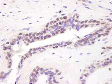 BRD8 Antibody - Detection of Human BRD8 by Immunohistochemistry. Sample: FFPE section of human prostate carcinoma. Antibody: Affinity purified rabbit anti-BRD8 used at a dilution of 1:1000 (1 ug/ml). Detection: DAB staining using Immunohistochemistry Accessory Kit.