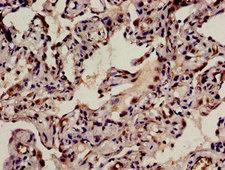 BRD8 Antibody - Immunohistochemistry analysis of human lung cancer at a dilution of 1:100