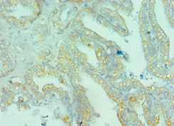 BRD9 Antibody - Immunohistochemistry of paraffin-embedded human bladder cancer using BRD9 Antibody at dilution of 1:100