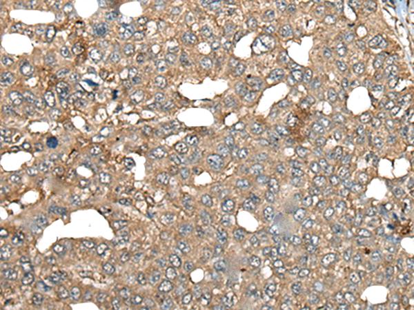 BRD9 Antibody - Immunohistochemistry of paraffin-embedded Human liver cancer tissue  using BRD9 Polyclonal Antibody at dilution of 1:80(×200)