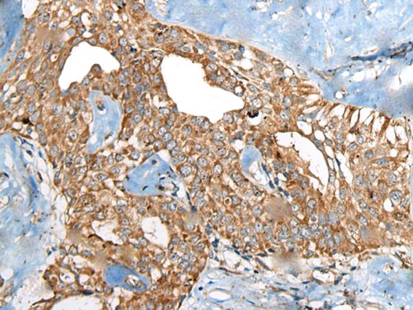 BRD9 Antibody - Immunohistochemistry of paraffin-embedded Human thyroid cancer tissue  using BRD9 Polyclonal Antibody at dilution of 1:80(×200)
