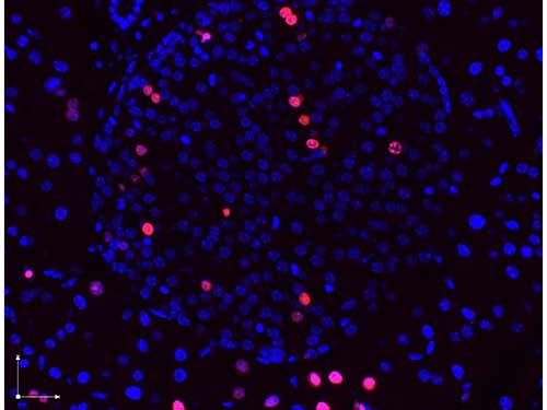 BrdU Antibody - Immunofluorescence microscopy images of paraformaldehyde-fixed, paraffin-embedded pancreas sections stained with antibodies against BrdU (red or pink) and counterstained with DAPI (blue) and imaged with a 40× objective. DAPI stained nuclei (blue) indicate non-dividing cells, immunostained red and pink nuclei indicate actively dividing pancreatic ß-cells. The antibodies were diluted to 2.7 µg/ml. and incubated with tissue sections overnight at 4 degrees. Donkey anti-rabbit secondary antibody was diluted 1:2500.